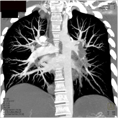Saddle Pulmonary Embolism - Chest Radiology Case Studies - CTisus CT ...