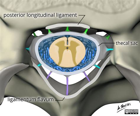 Radiopaedia - Drawing Ligamentum flavum, posterior longitudinal ligament and thecal sac ...