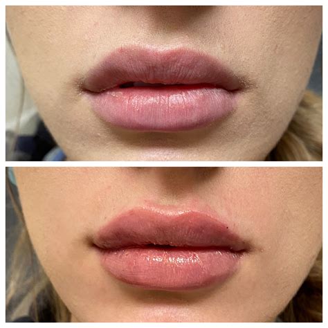 Learn What Type of Lip Fillers are Best for You | Laser Lipo and Veins