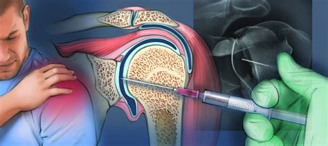 Image result for Arthogram Explained