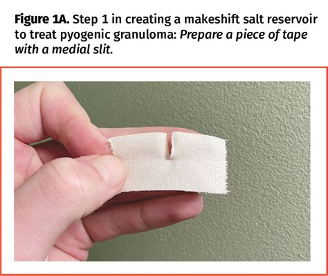 Simple, safe, and effective treatment for pyogenic granuloma | The College of Family Physicians ...