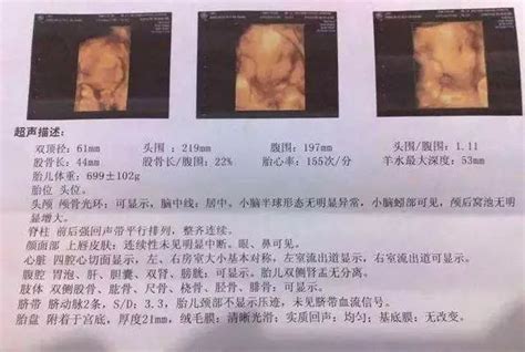 怀孕18周胎儿b超图_百度宝宝知道-怀孕37周胎儿b超图