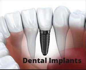 Oral implants -- The paradigm shift in restorative dentistry