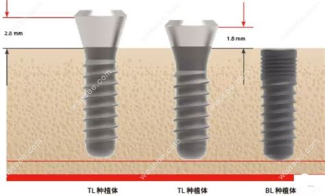 iti愈合帽,种植牙愈合帽,愈合帽_大山谷图库