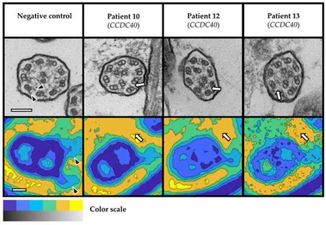 Ciliary Ultrastructure Assessed by Transmission Electron Microscopy in ...