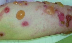 Bullous Pemphigoid - Bullous Pemphigoid - MSD Manual Professional Edition