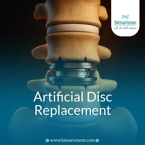 Artificial Disc Replacement: A Modern Alternative to Spinal Fusion for Herniated Discs