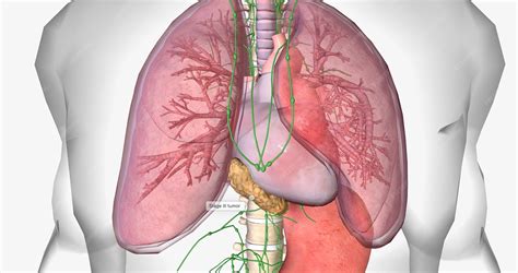 Premium Photo | In stage iii esophageal cancer the tumor has spread ...