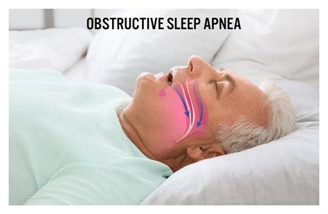 Image result for Obstructive Sleep Apnea