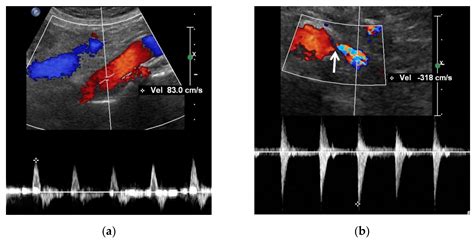 Kidney Artery Stenosis Ultrasound at Christina Aguirre blog