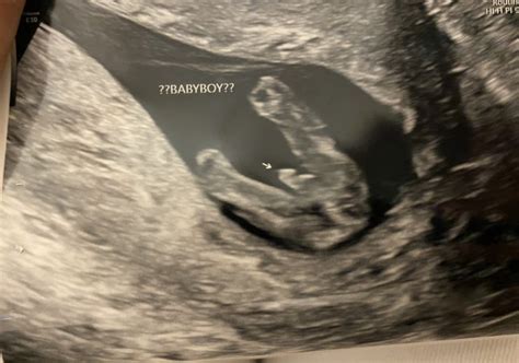 Bildergebnis für normal umbilical cord ultrasound