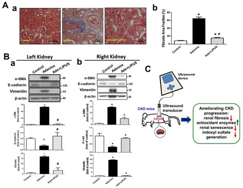 Therapeutic Ultrasound Halts Progression of Chronic Kidney Disease In ...
