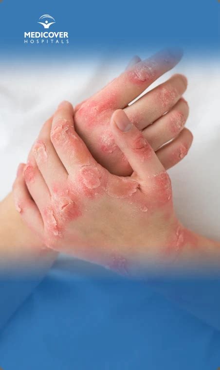 Rash with Fever: Causes and Solutions