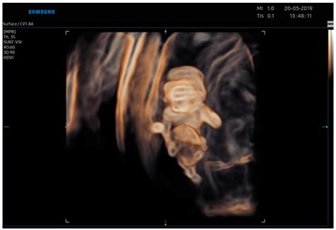Body Stalk Anomaly Complicated by Ectopia Cordis: First-Trimester ...