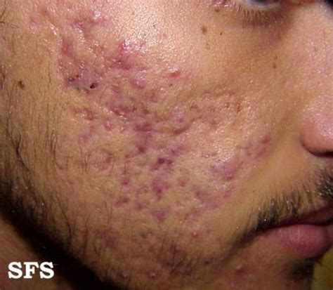 Skin Staph Infections with Pictures | HubPages