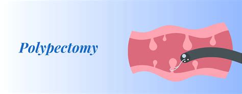 Image result for Polypectomy Recovery