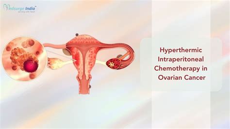 Image result for Intraperitoneal Injection Ovarian Cancer