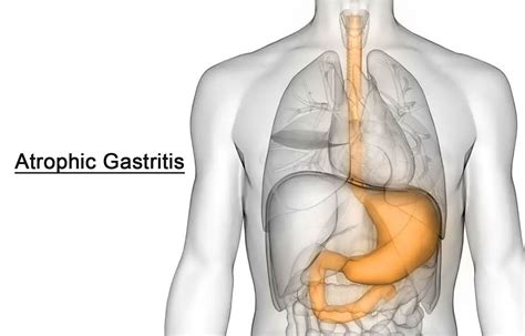 Diagnosis and Management of Atrophic Gastritis: AGA Clinical Practice ...