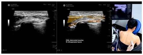Infraspinatus Fascial Dysfunction as a Cause of Painful Anterior ...