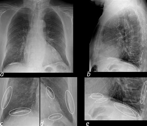 Lungs Pleural Calcification (CXR) | The Common Vein