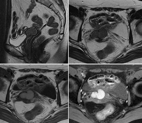 Vaginal Inclusion Cysts