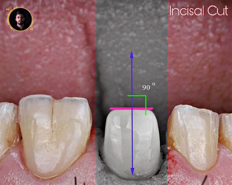 Line Angle Teeth 的图像结果