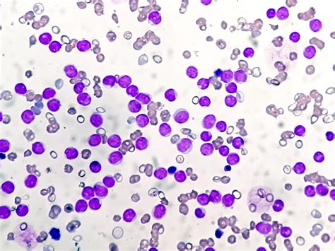 Linfoblasto en examen microscópico leucemia linfoblástica aguda lla | Foto Premium