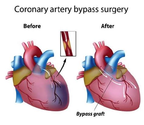 Coronary Artery Bypass Grafting (CABG)