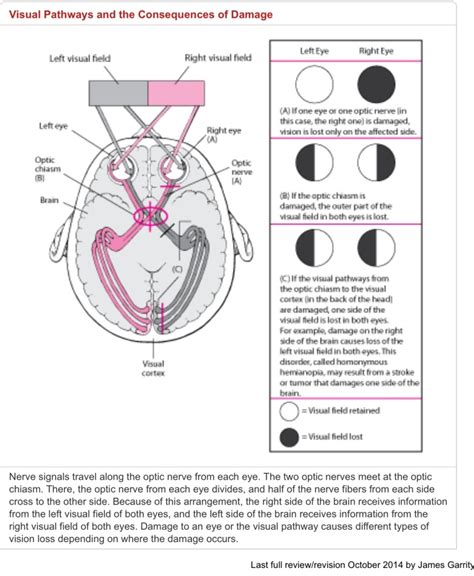 Image result for Visual Deficit Chart