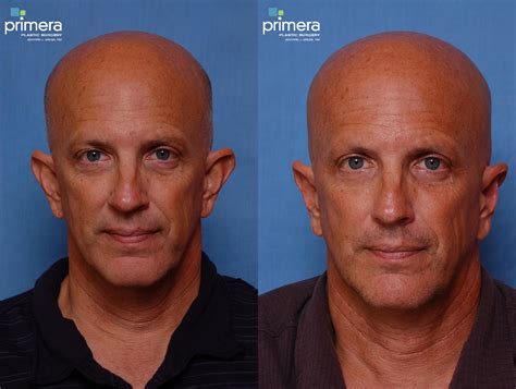 Ear Surgery (Otoplasty) Before and After Pictures Case 321 | Orlando, Florida | Primera Plastic ...