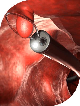 Image result for Colono Looping Colonoscopy