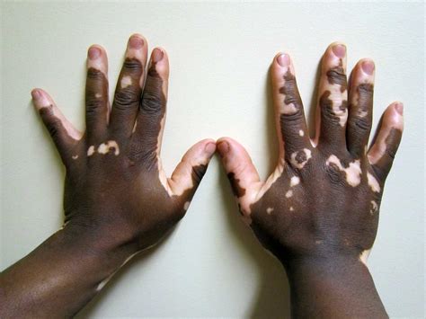 Explainer: what is vitiligo?