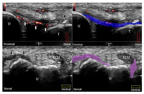 Ulnar Collateral Ligament Thumb Ultrasound