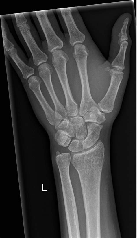 Image result for Normal X-ray