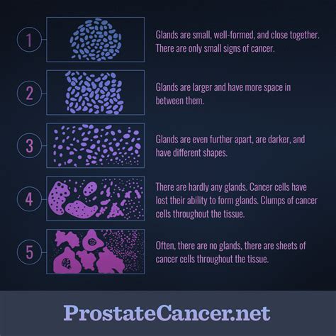 What Is Gleason Score? | ProstateCancer.net