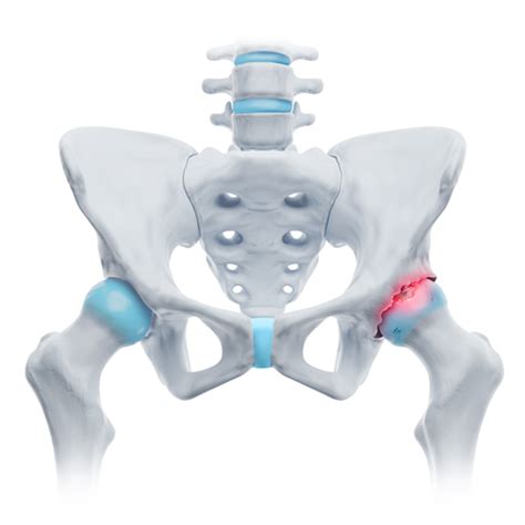 Coxarthrosis – Ailments - Bort