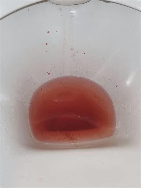 ⚠️URGENT⚠️ Bloody urine, period 14 days early, black discharge ...