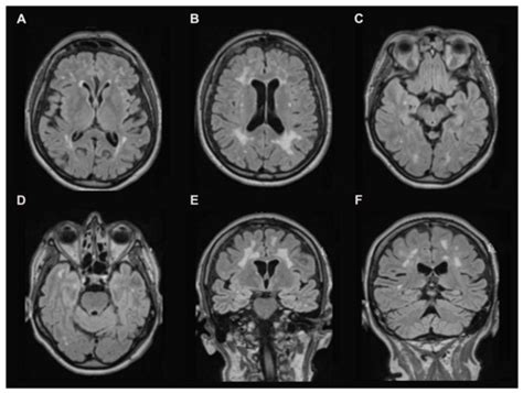 An Atypical Case of Head Tremor and Extensive White Matter in an Adult ...