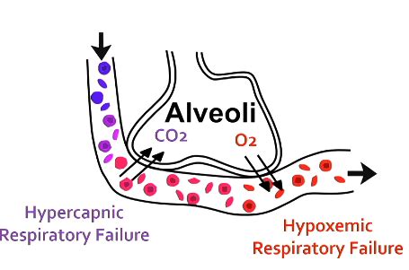 Image result for PaO2/FiO2 Alveoli