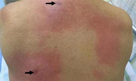 Wasp Sting Infection Signs