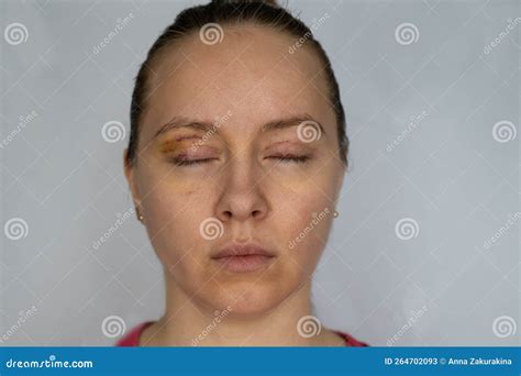 Woman Face Recovery after Plastic Surgery, Blepharoplasty Operation, Visible Eyes Wound Cuts ...