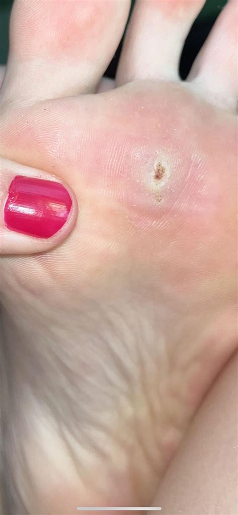 My plantar wart. Been putting ACV on it for over a month, I let it get ...
