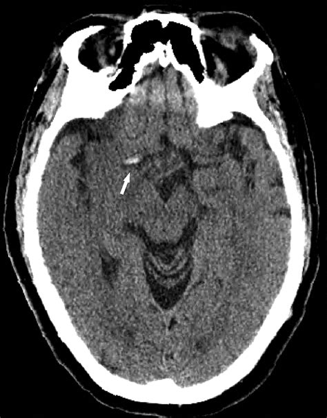 Stroke Brain Clot