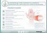 El síndrome del túnel carpiano y el ligamento transverso del carpo ...