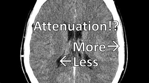 What Does Attenuation Mean in Radiology? - Rad Insights