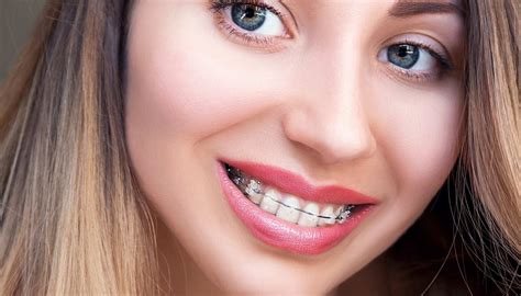 Types of Orthodontic Braces - Burke & Redford Orthodontists