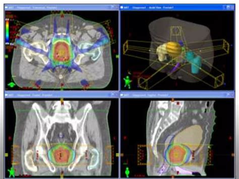 Prostate Radiation Simulation 的图像结果