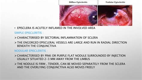 EPISCLERITIS AND SCLERITIS OF THE EYE BALL | PPT