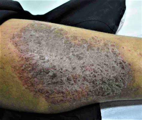 Lichenification of skin causes and how to get rid of lichenification