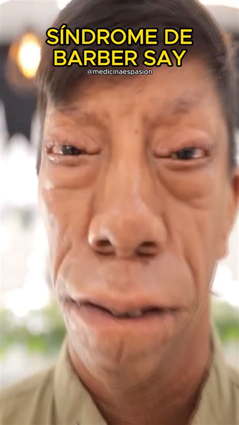 Sindrome Barber Say